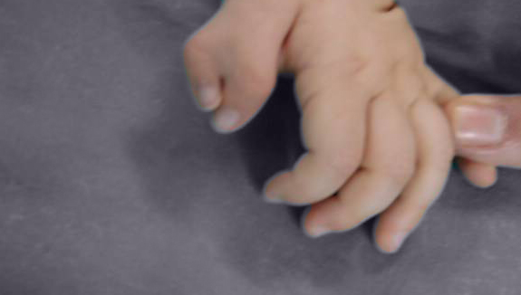 Preaksijalna polidaktilija - jedan dan nakon operacije